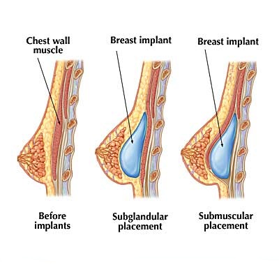 breast surgery at cyprus.jpg